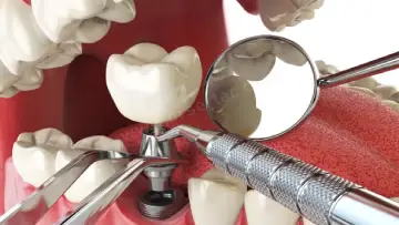 Diş İmplantı